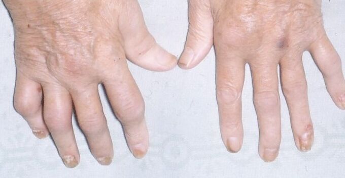 artropatia łuszczyca na dłoniach
