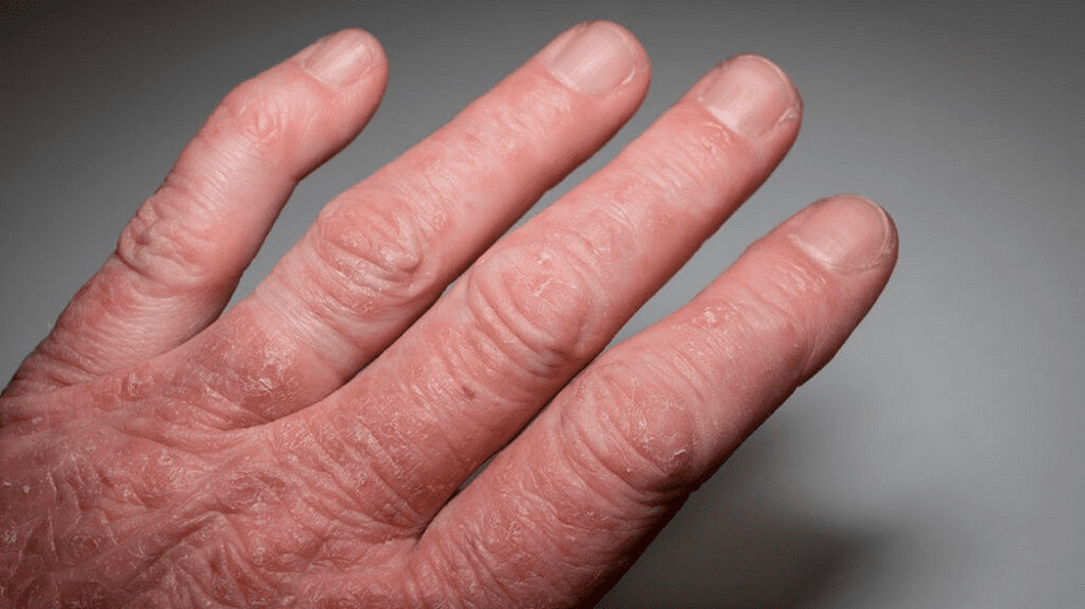 łuszczycowe zapalenie stawów rąk