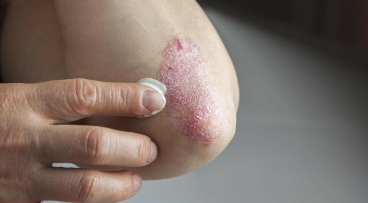 Łuszczyca wpływająca na skórę, której leczenie obejmuje stosowanie maści