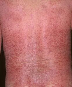 Erytrodermia