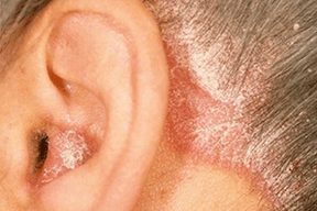 przyczyny łuszczycy