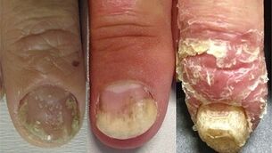 etapy rozwoju łuszczycy paznokci