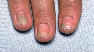 przyczyny łuszczycy na paznokciach